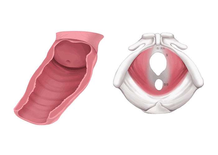 질 축소술 단면도 뼈