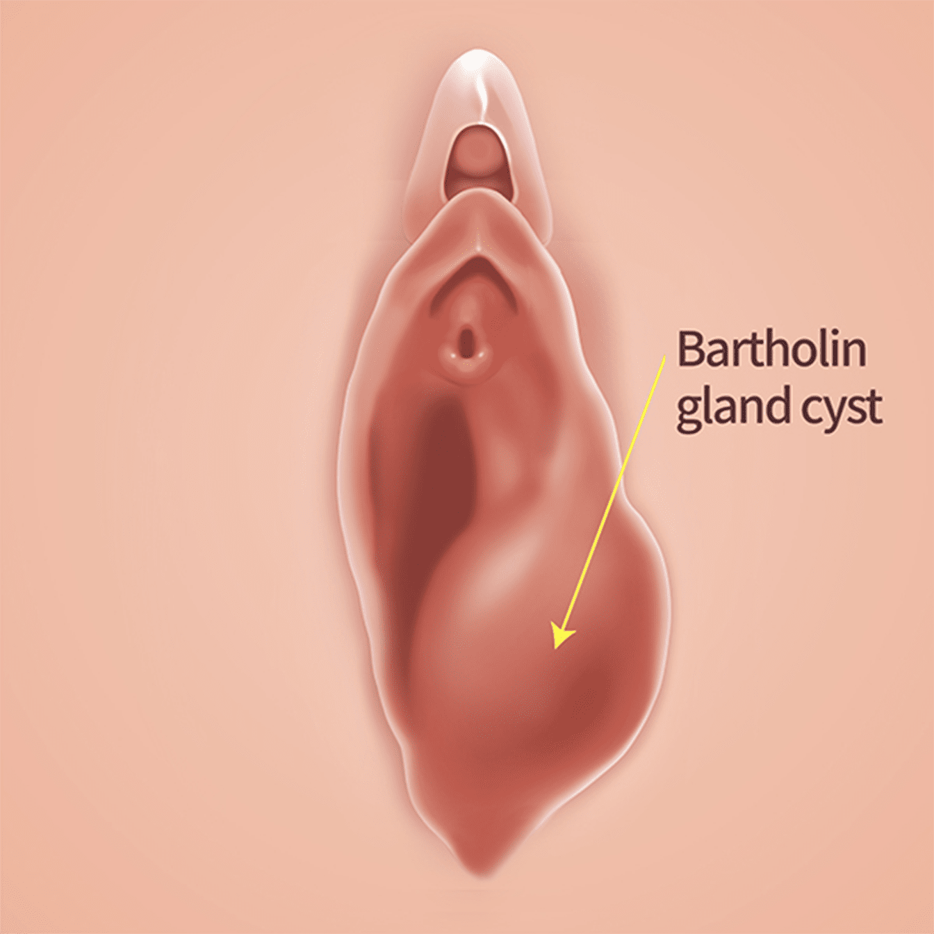 바르톨린 낭종 조대술