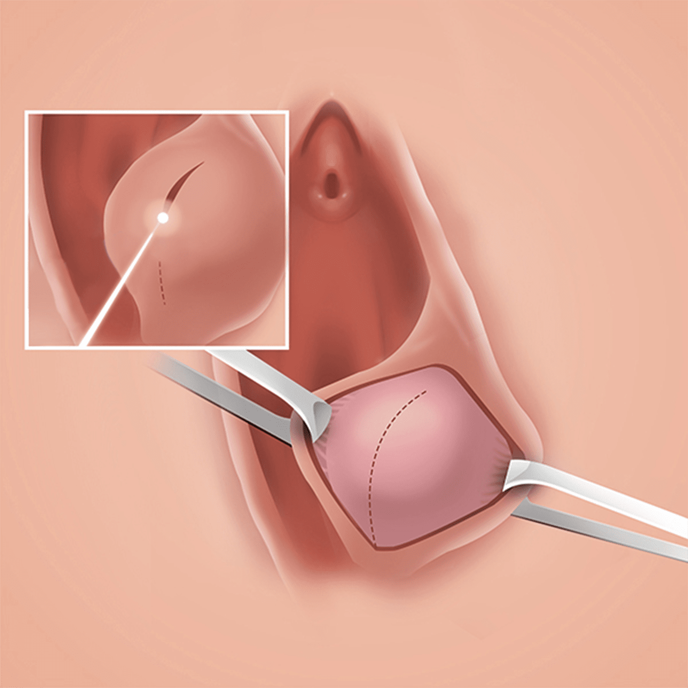 바르톨린 낭종 조대술