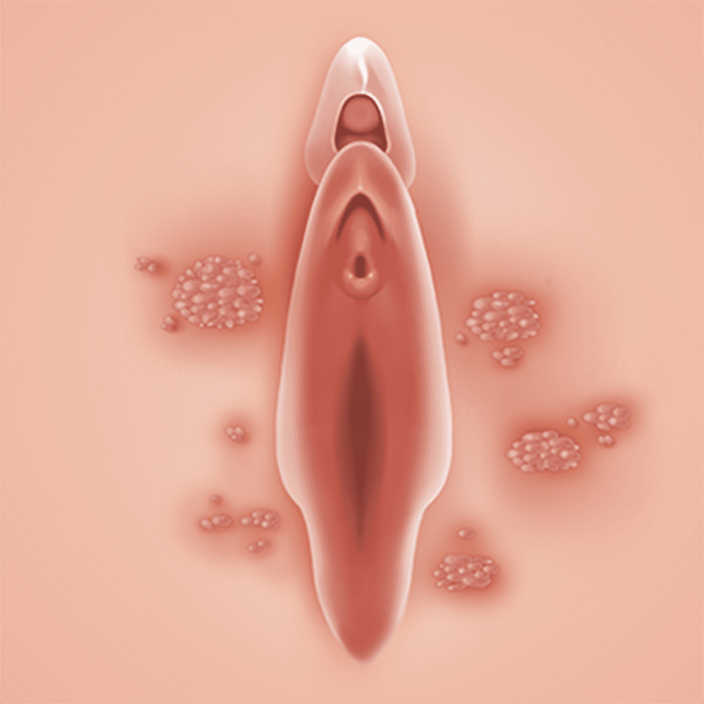 콘딜로마 (곤지름)