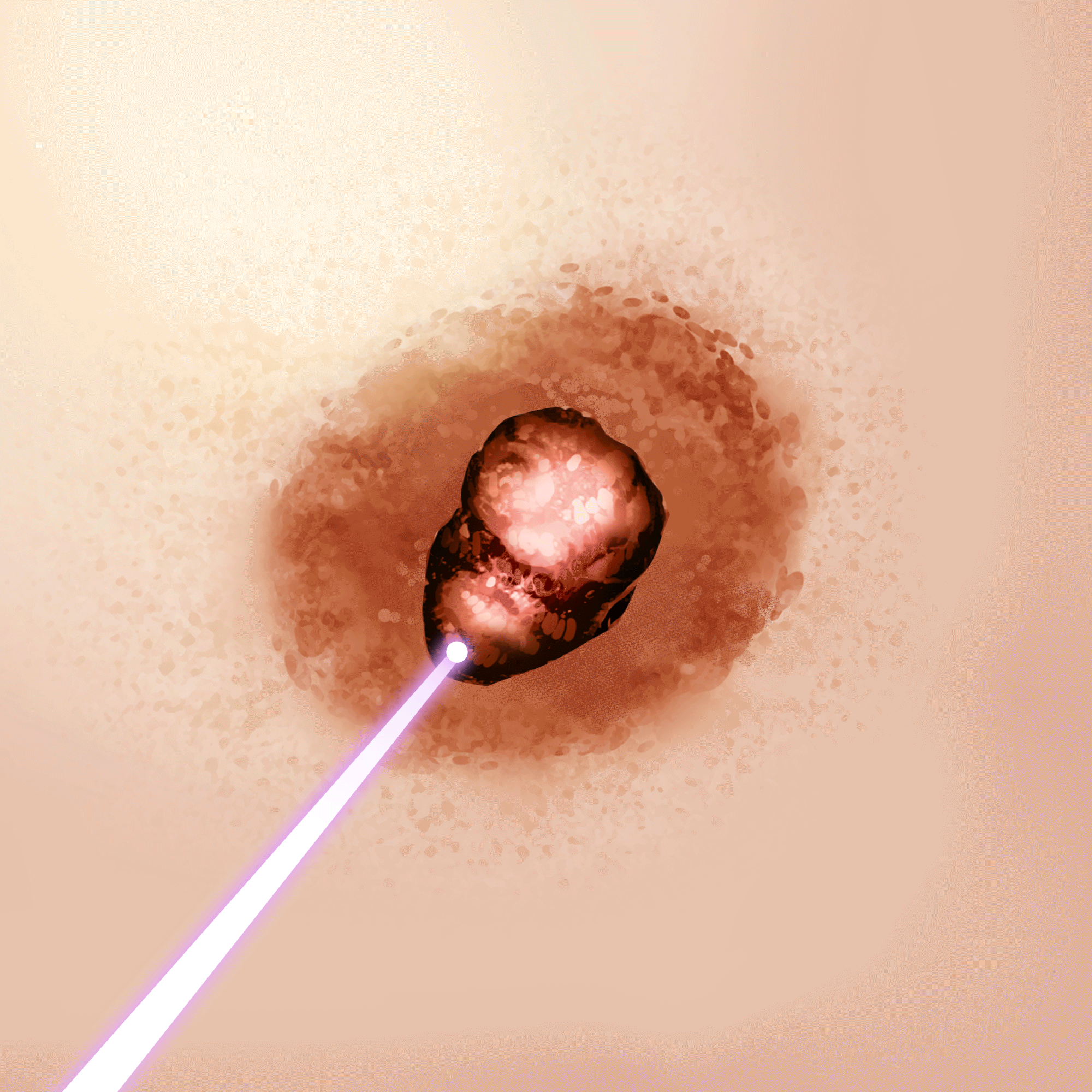 유두 축소 레이저 정면